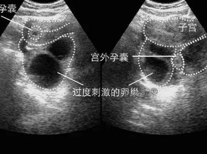 2026各省失独家庭试管助孕条件！失独家庭申请精卵要排队吗？